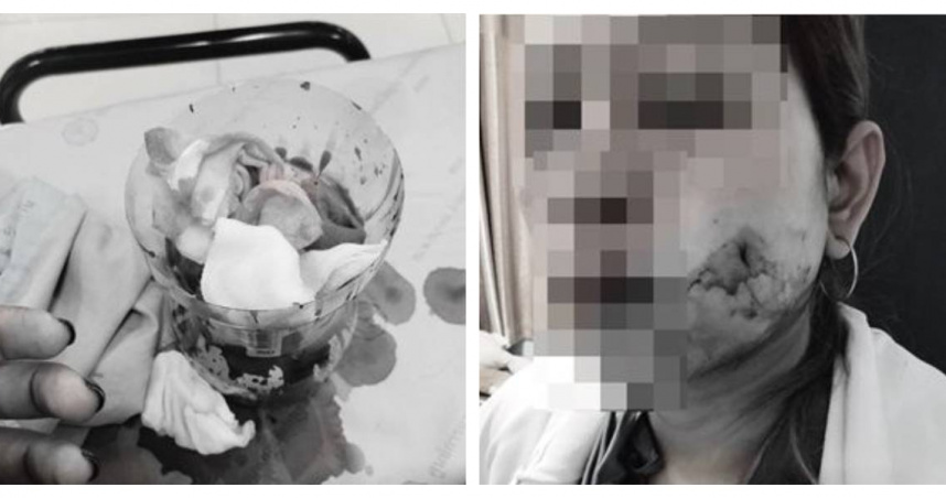 泰國一名女子希望擁有一對迷人的酒窩，未料術後右臉頰傷口持續出血，時間甚至長達2個月，讓她一度暈死。（圖／翻攝自 ต้นอ้อ เป็นหนึ่ง臉書）