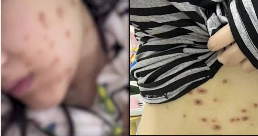 大陸一名18歲女學生買貓當生日禮物，帶回家不到一個星期發現自己全身多處異常紅腫，就醫被診斷為嚴重貓癬，寵物業者卻拒絕賠償。（圖／翻攝自微博／搜狐千里眼）