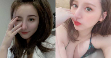 半夜遭熊孩突襲!小歪「鼻子位移」整型險變朝天鼻 術後4個月成果曝光
