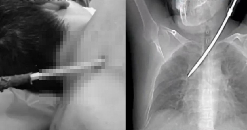 大陸廣東26日驚傳一起驚悚事故，一名44歲男電梯工人蹲下作業，卻遭一把從高空墜落約有30公分長的螺絲起斯插進胸膛，所幸送醫救治後已脫離生命危險。（圖／翻攝自微博）