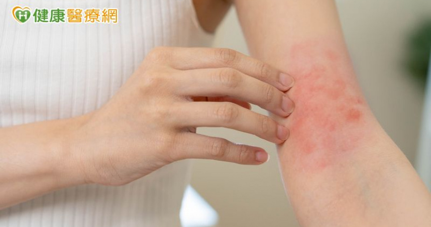 異位性皮膚炎來勢洶洶！　醫授「日常3大保養原則」一定要做到