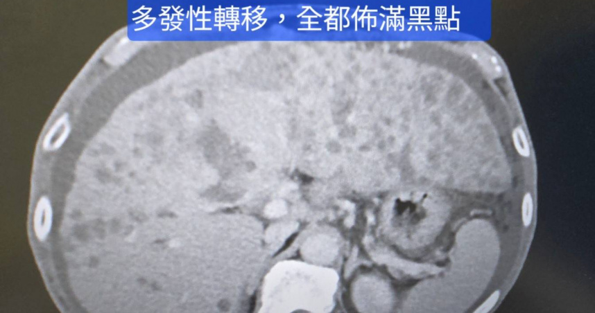 患者自信過去靠草藥治好肝病，選擇自行服藥，未料4個月後再度就醫時，肝癌已快速擴散。（圖／翻攝自臉書，肝膽胃腸科林群峰醫師 - 大腸鏡胃鏡專科）