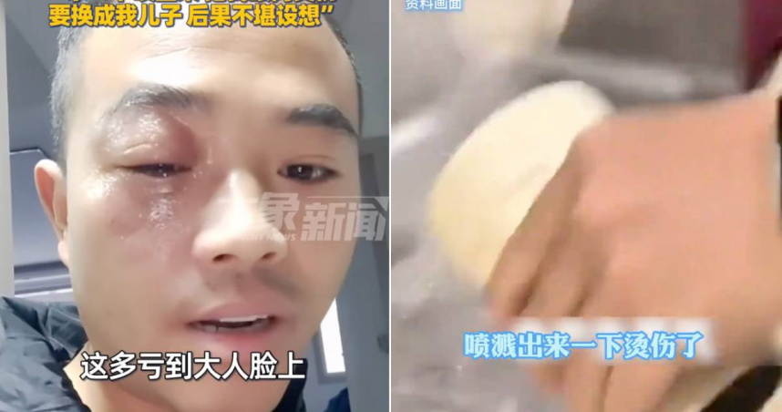 一名父親被保溫瓶噴出的熱水燙傷眼窩。（圖／翻攝大象新聞）