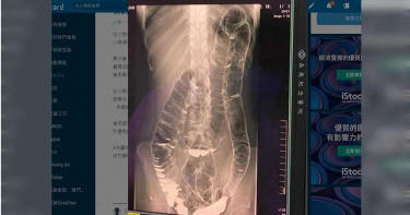 23歲女「最長17天沒大便!」 X光片驚見大腸「長到心臟了」