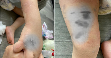 併桌客人打翻熱湯灑3歲男童 手腳嚴重燙傷大面積起水泡