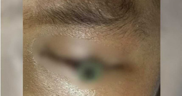 割草機噴射金屬螺絲!狠插3歲小弟眼窩…鮮血狂流慘成眼中釘