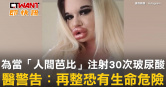 圖說-為當「人間芭比」注射30次玻尿酸　醫警告：再整恐有生命危險