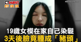 圖說-19歲女模在家自己染髮　3天後臉竟腫成「豬頭」