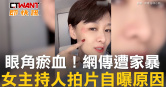 圖說-眼角瘀血！網傳遭家暴　女主持人拍片自曝原因