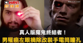 圖說-真人版魔鬼終結者！男罹癌左眼摘除改裝手電筒瞳孔
