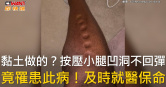 圖說-黏土做的？按壓小腿凹洞不回彈　竟罹患此病！及時就醫保命