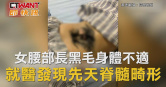 圖說-女腰部長黑毛身體不適　 就醫發現先天脊髓畸形